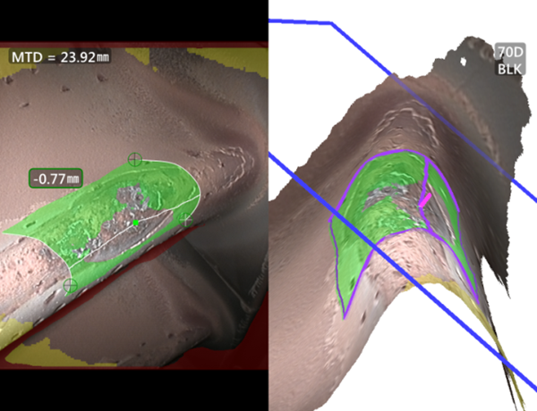 使用三維測量工業內窺鏡測量凹坑深度 使用三維測量工業內窺鏡測量凹坑深度